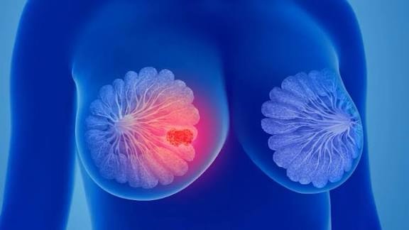 Falta de acesso a mamógrafos limita prevenção do câncer de mama